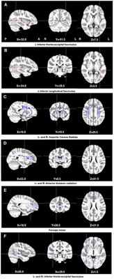 White Matter Abnormalities in Children with HIV Infection and Exposure